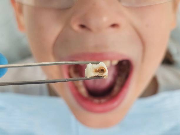 Best Emergency Wisdom Teeth Removal in Fort Bliss, TX